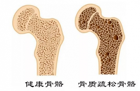 骨质疏松可防可治