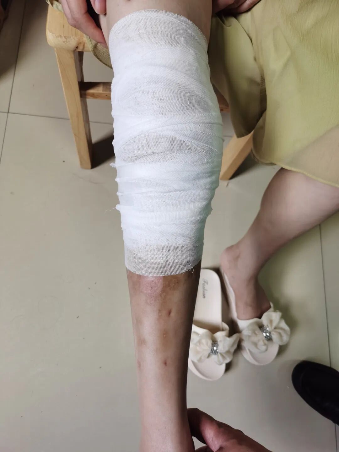 【福德康复】无痛疗愈新选择——中药外敷