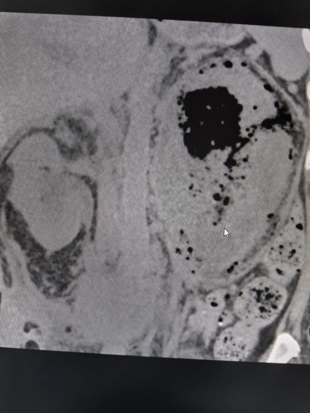 莆田福德医院泌尿肾病科成功救治气肿性肾盂肾炎重症感染患者