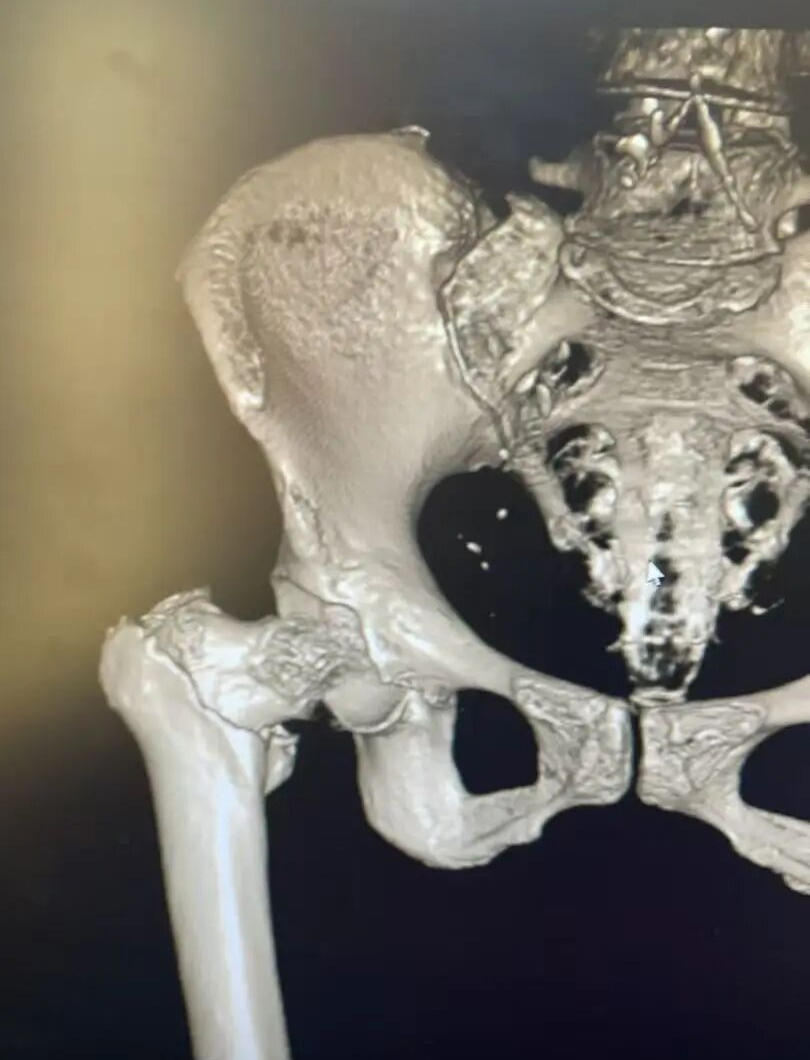 【福德骨科】微创手术攻克“人生最后一次骨折”，让高龄不再是禁区！