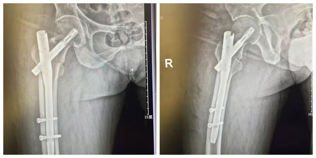 【福德骨科】微创手术攻克“人生最后一次骨折”，让高龄不再是禁区！
