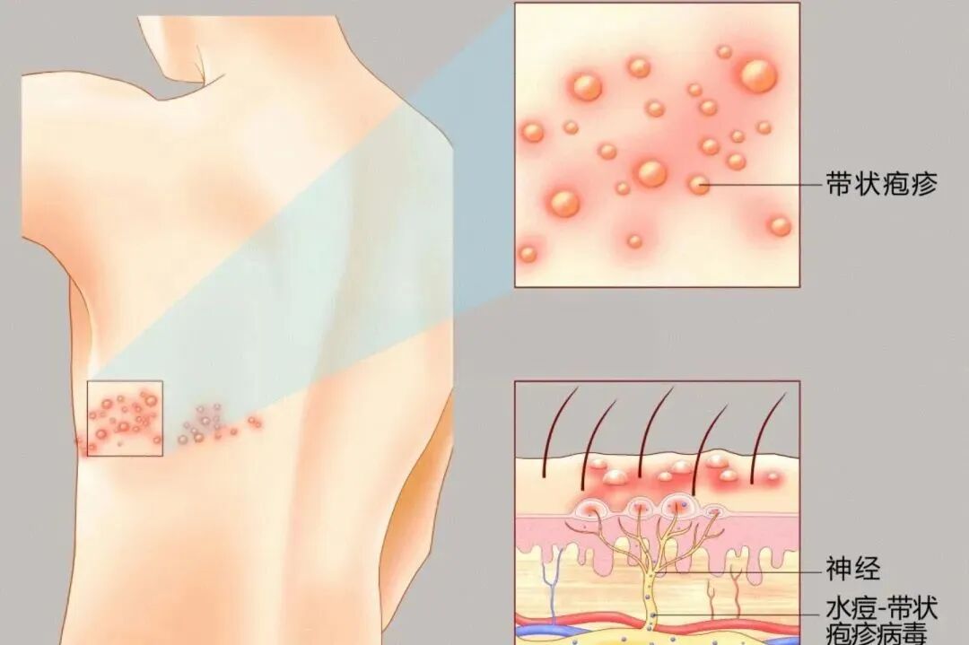 【福德康复】中医火针，助您告别“缠腰龙”之痛！