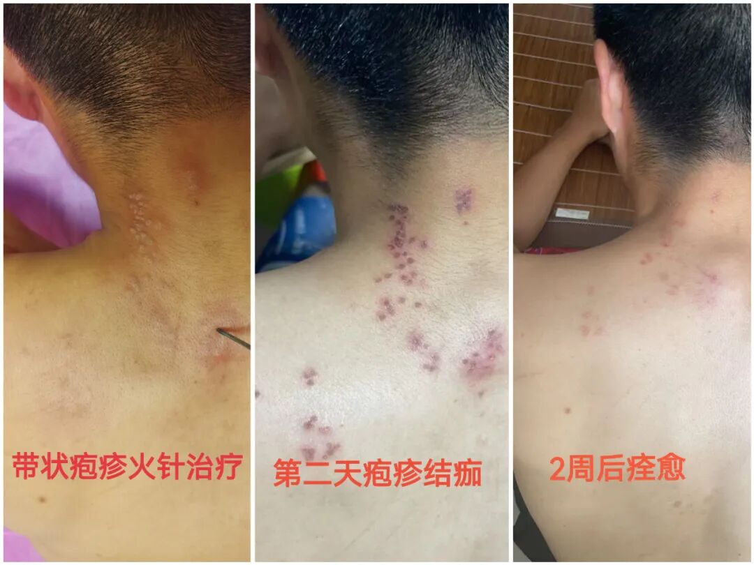 【福德康复】中医火针，助您告别“缠腰龙”之痛！