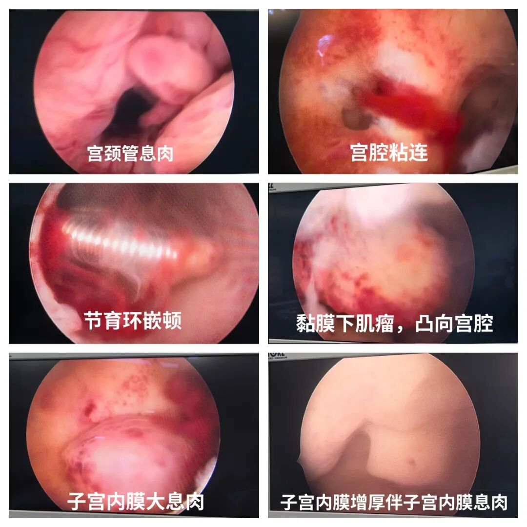 【福德妇科】宫腔镜技术，精准守护你的“生命宫殿”